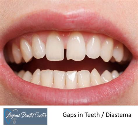 Invisalign Aligners Orange County Ca Laguna Dental Center