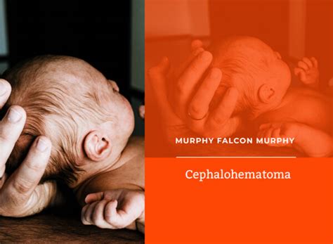 Cephalohematoma Cephalohematoma