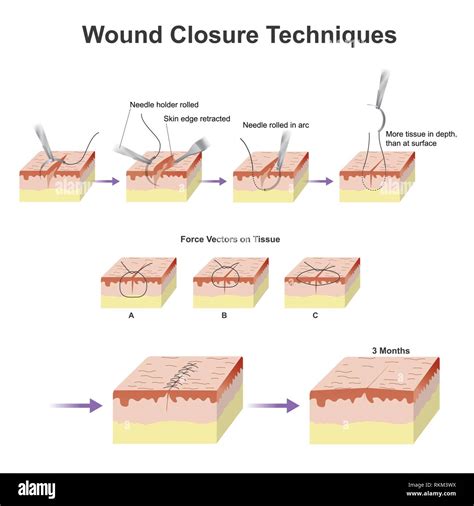 Types Of Blunt Trauma