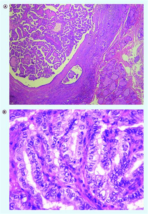 A Papillary Thyroid Carcinoma Lower Right Corner Indicating Normal