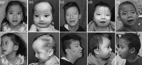 Further Phenotypic Characterization Of Kaufman Oculocerebrof