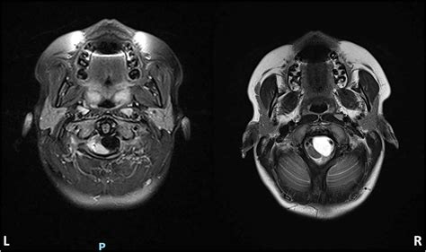 Composite of axial MRI at level of foramen magnum in T1-W mode (L) and ...