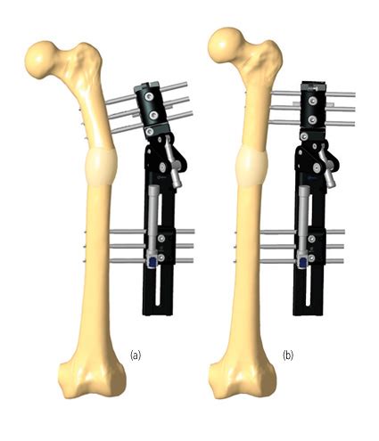 Correction Of Femur Deformity Following Lengthening Orthofix Abs