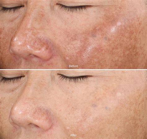 List 90 Pictures Chemical Peels Before And After Pictures Stunning