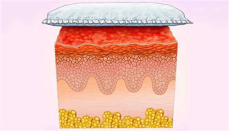 Qu Es La Dermatitis Del Pa Al