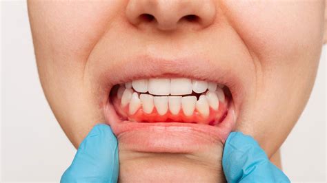 What Your Teeth And Oral Health Reveal About Your Health Onlymyhealth