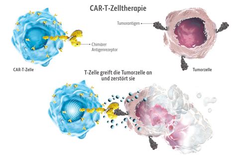 CAR T Zelltherapie BMS Pflege Onkologie