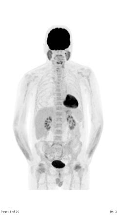 Pet Scan Lymphoma Stage Iv