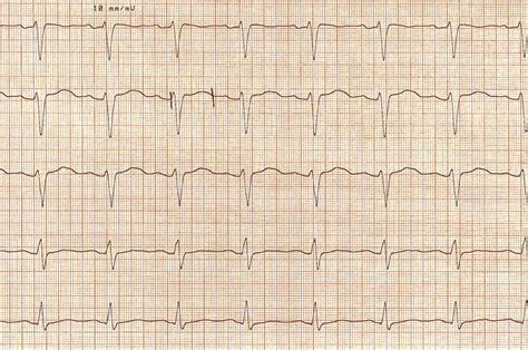 Long Qt Syndrome The Pharmaceutical Journal