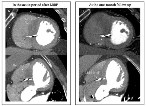 Frontiers Case Report Interventricular Septal Hematoma Complicating