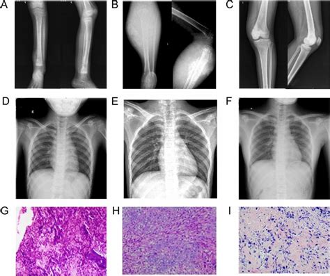 X Ray and the pathological result. X Ray of tibia (A) and chest (D) and... | Download Scientific ...