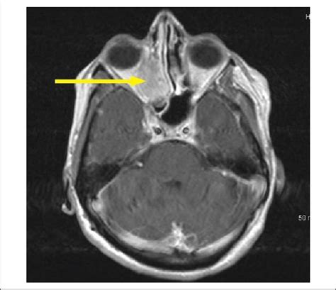 Magnetic Resonance Imaging Right Retro Orbital Area With The Suspected