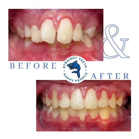 Improving Your Smile To Make It Look More Beautiful Achieving Proper