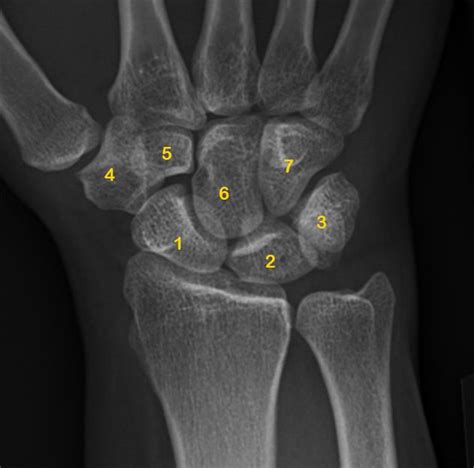 Carpal bones | Radiology Reference Article | Radiopaedia.org ...