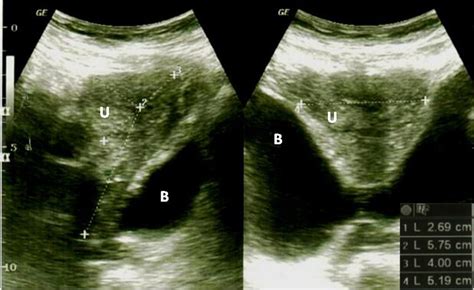 Good Attachment Of Uterus To The Abdominal Wall Can Be Observed On Download Scientific Diagram