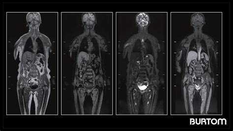 Manyetik Rezonans Görüntüleme Nedir 3 Tesla MRG Burtom