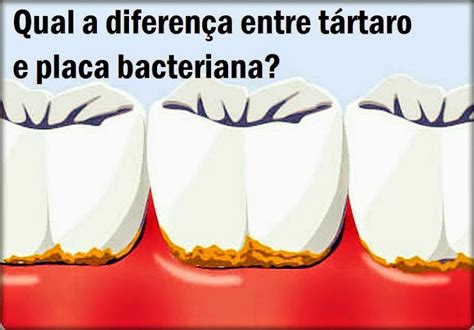 SAÚDE BUCAL Qual a diferença entre tártaro e placa bacteriana