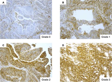 Human Leukocyte Antigen Hla Class I Expression In Tumor Cells