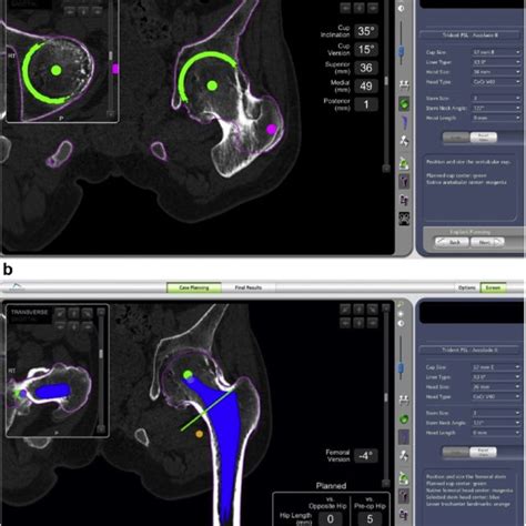 Preoperative Planning For A Acetabular And B Femoral Components On