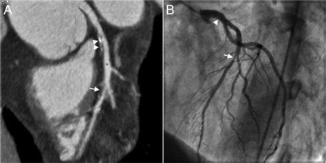 Role Of Noninvasive Imaging In The Diagnosis Of Cardiac Allograft