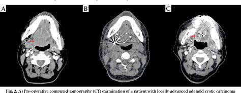 Table 1 From The Efficacy Of Iodine 125 Interstitial Brachytherapy For The Treatment Of Locally