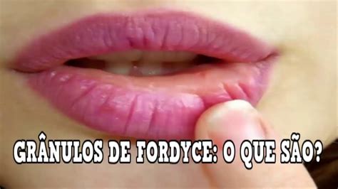 Manchas O Granos De Fordyce Labios Tatuados Letra