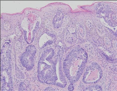 Figure 2 From Cutaneous Metastatic Rectal Adenocarcinoma In Zosteriform Distribution Semantic