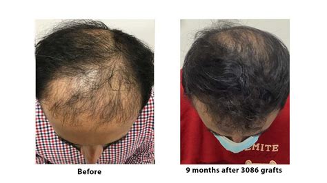 Hair Transplant Before And After Resultsdr Bermanartas Robotic Hair