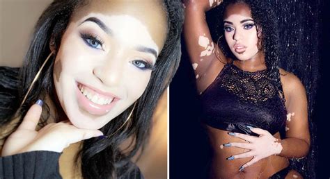 Model with vitiligo accused of 'trying to be white'