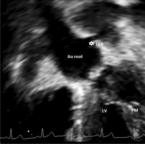 Modified Apical Chamber View Showing High Take Off Of Left Coronary