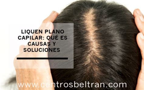 Liquen Plano Capilar Qu Es Causas Y Soluciones Centros Beltr N