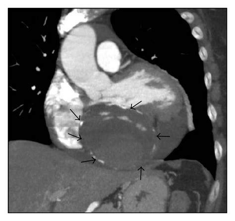 Multidetector Computed Tomography Mdct Multiplanar Reconstruction Download Scientific Diagram