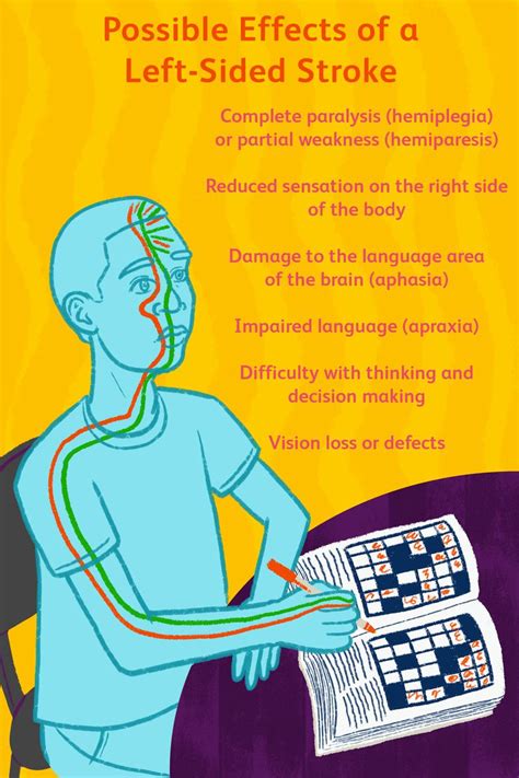 Left Sided Stroke Signs Long Term Effects And Treatment