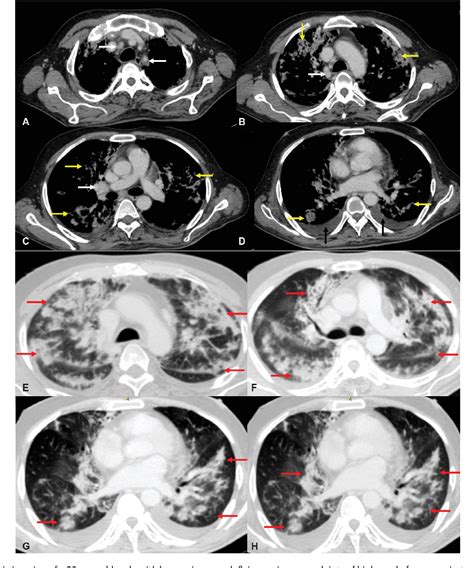 Figure 19 From Imaging Approach To Pulmonary Infections In The Immunocompromised Patient