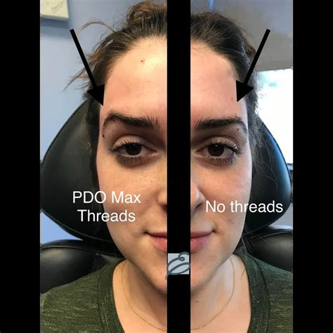 What To Expect When Getting A Pdo Thread Lift 57 Off