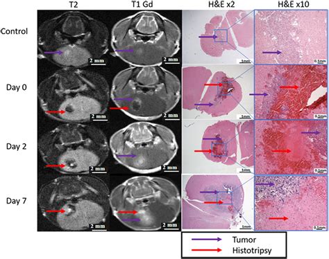 Histotripsy Treatment Of Murine Brain And Glioma Temporal Profile Of