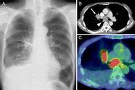 Tuberculosis Associated Chylothorax Revealing An Enlarged Lymphatic