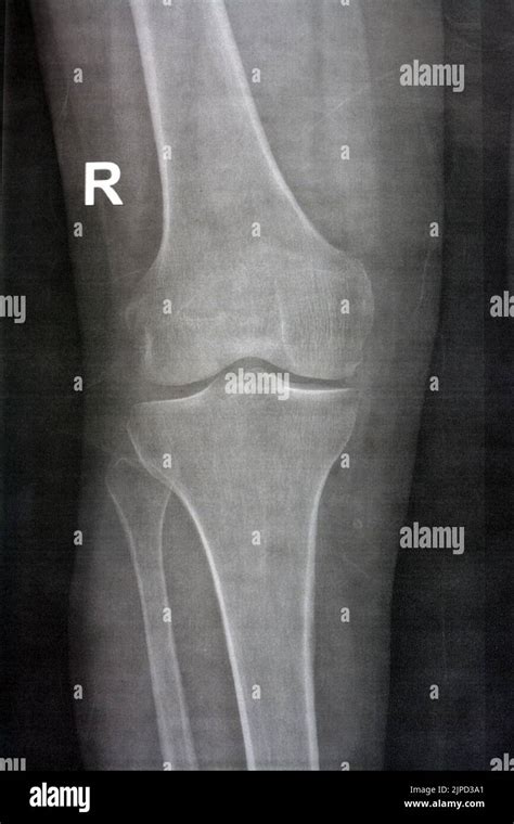 Plain X ray of the right knee shows apparent joint osteoarthritis according to Kellgren and ...