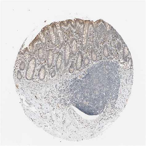 Tissue Expression Of ALK Staining In Appendix The Human Protein Atlas