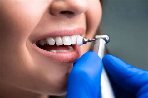 Realizar una limpieza dental cada cuánto tiempo Myodent