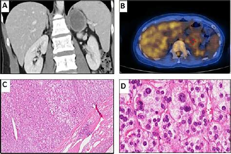 Frontiers Adrenal Tumor Mimicking Non Classic Congenital Adrenal