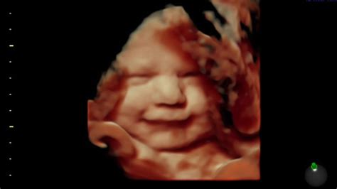 What Is A 4d Ultrasound Scan Importance And How It Works