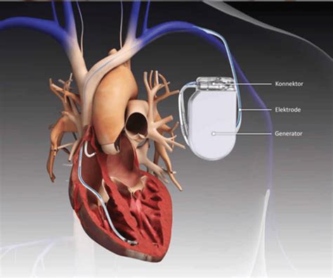 Pacemaker ICD CRT CRT D CRT P Heart Center Ranchi