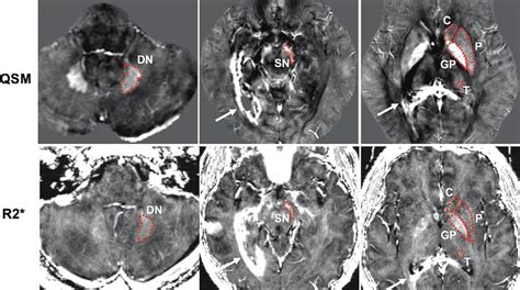 Axial Quantitative Susceptibility Mapping QSM Top Row And R2