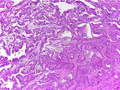 Polycystic Kidney Disease Histology