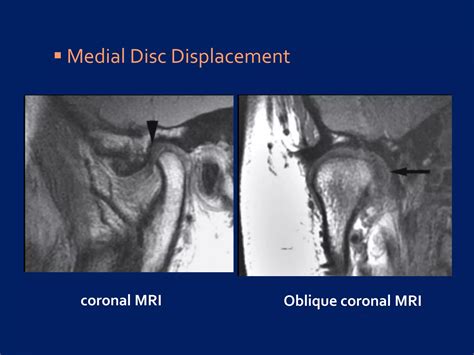 Undestanding Tmj Internal Derangements 1 Pdf