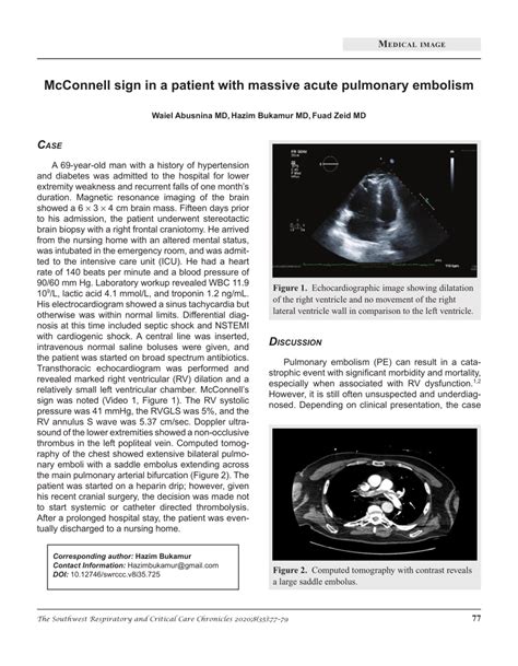 (PDF) McConnell sign in a patient with massive acute pulmonary embolism