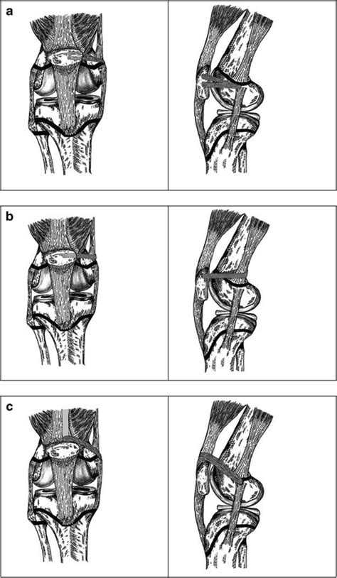 Proximal Reconstructions All Artwork Original And Drawn By Evan