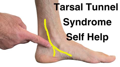 7 Tips For Treating Tarsal Tunnel Syndrome YouTube