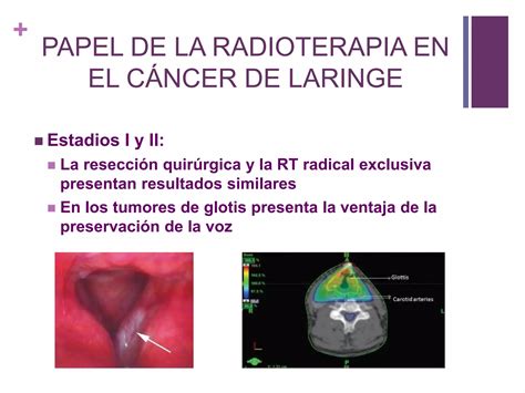 Manejo Multidisciplinar Del Cáncer De Laringe Papel De La Radioterapia